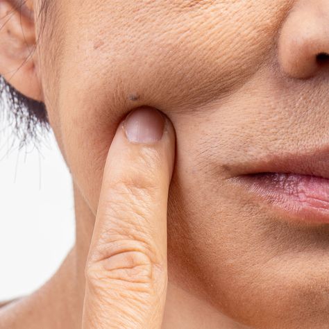 What Are Milia Spots? A Dermatologist Explains The Common Aging Skin Condition And How To Treat It - SHEfinds Hair Elixir, Lipstick Hacks, Aging Beauty, Uneven Skin Texture, Thin Hair Haircuts, Dull Hair, Undereye Circles, Best Oils, Sagging Skin