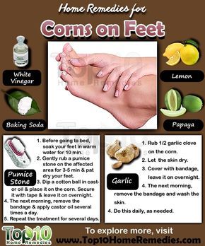 Prev post1 of 3Next Corns are small circles of hard, thickened skin that develop when the skin is exposed to excessive pressure or friction. Corns most often develop on the feet, especially on the tops and sides of the toes, soles of your feet and even between the toes. They can also develop on other Corn Removal, Cooking With Turmeric, Top 10 Home Remedies, Natural Healing Remedies, Diy Remedies, Homemade Beauty, Natural Therapy, Skin Remedies, Natural Diy