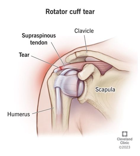 Reverse Shoulder Replacement, Rotator Cuff Surgery, Shoulder Problem, Arm Bones, Rotator Cuff Tear, Shoulder Impingement, Rotator Cuff Injury, Magnetic Resonance, Rotator Cuff