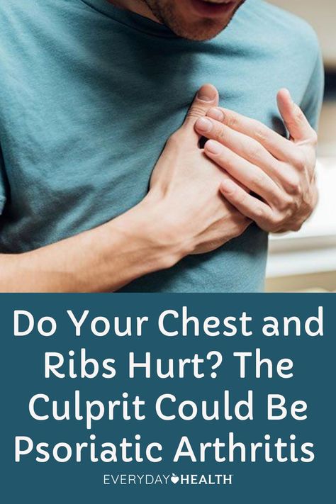 Psoriatic arthritis can sometimes lead to chest or rib pain. Blame costochondritis, an inflammation of the cartilage connecting the ribs and the breastbone. Rib Pain, Ic Diet, Joints Pain Remedy, Arthritic Pain, Chronic Pain Management, Ligaments And Tendons, Chronic Pain Relief, Nerve Pain Relief, Ehlers Danlos