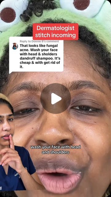 Dr. Neera Nathan on Instagram: "Head & Shoulders is not just for dandruff. It contains pyrithione zinc, which is anti-fungal and antibacterial, making it one of the cheapest home remedies for a variety of skin conditions.

For fungal acne: “Fungal” acne is actually malassezia (pityrisporum) folliculitis and is caused by the same yeast as dandruff. It presents as tiny, itchy monomorphic bumps on the forehead and hairline. H&S can be used as a face wash to help clear this condition. To use as a face wash, lather it on the face, leave it on for 2 minutes, then rinse off. Use 2-3x per week. 

For seborrheic dermatitis: Seborrheic dermatitis is dry, flaky skin that occurs in between/around the eyebrows, on the side of the nose & behind the ears. It is related to dandruff. H&S can be used as a f Fungal Acne On Forehead, Forehead Acne Home Remedies, Head And Shoulders For Acne, Tiny Bumps On Forehead, Tiny Bumps On Face, Dry Flaky Skin On Face, Dry Skin Remedies For Face, Forehead Acne Cause, Eyebrow Dandruff