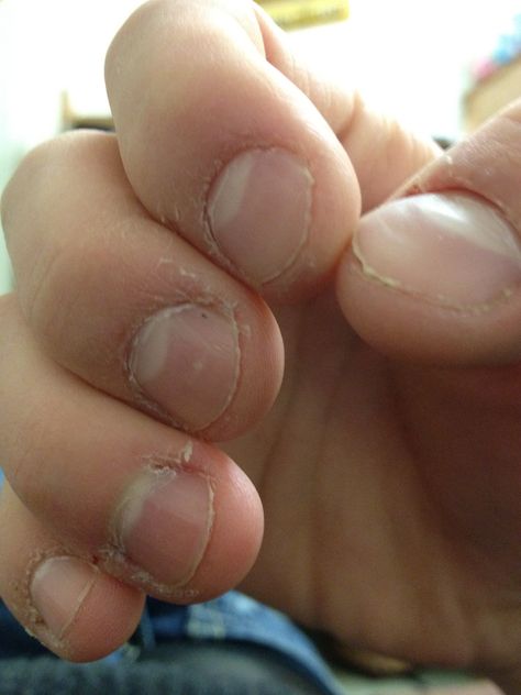 Tips to help stop nail biting Nail Biting Remedies, Nail Growth Remedies, Stop Nail Biting, Nail Biting Habit, Mirror Nail Polish, Gel Nails At Home, Mirror Nails, Nail Biting, Nail Growth