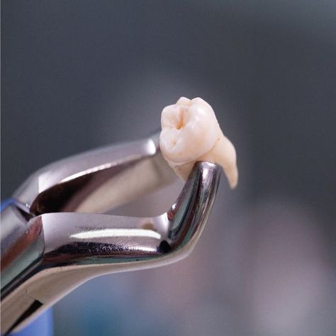 RECENT STUDIES show that a nanoscale view of tooth enamel could lead to a solution for enamel-regenerating tooth treatments! Tooth Extraction Aftercare, Tooth Extraction Healing, Sensitive Teeth Remedy, Wisdom Tooth Extraction, Dental Implants Cost, Wisdom Teeth Removal, Tooth Removal, Pediatric Dental, Teeth Implants