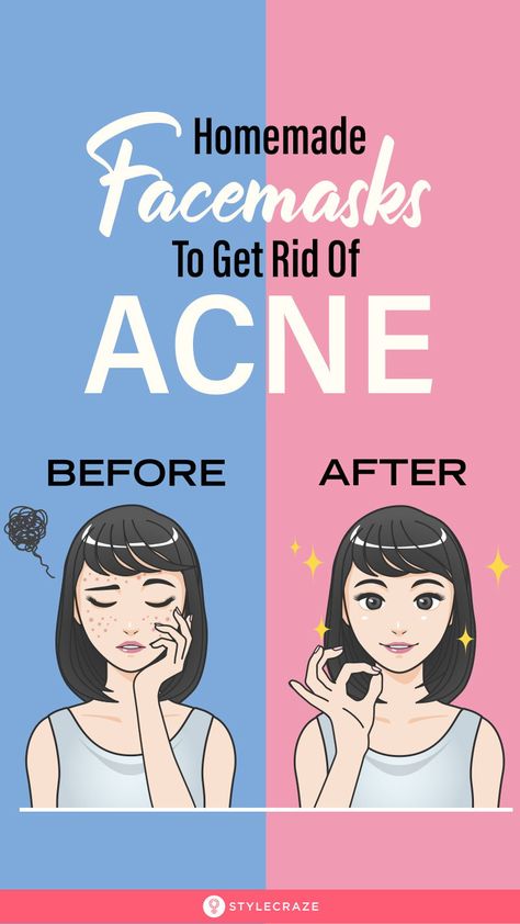 Face Mask For Pimples, Pimple Free Skin, Homemade Face Pack, Forehead Acne, Acne Free Skin, Acne Skincare, Diy Acne, Natural Acne Remedies, Get Rid Of Acne