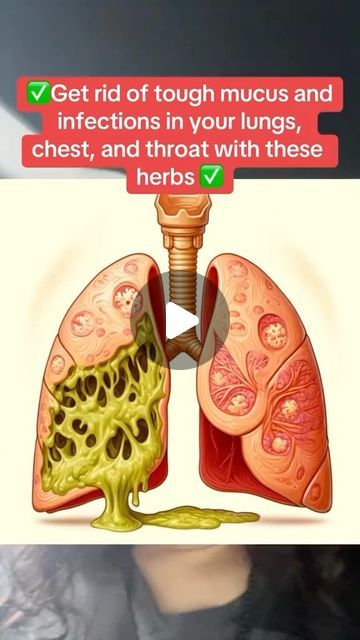 Foods For Mucus Relief, Remedies For Mucus In Chest, How To Get Rid Of Phlegm In Chest, Lung Exercises For Pneumonia, Mucus Cough Remedies, Rid Body Of Mucus, How To Get Mucus Out Of Chest, Fluid In Lungs Remedies, How To Get Rid Of Pleghm In Throat