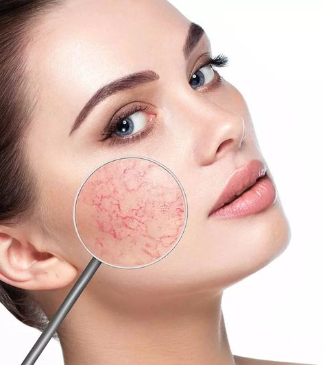 Latest Skin Healing Remedies, Redness On Face, Facial Veins, Home Remedies For Wrinkles, Permanente Make-up, Vein Removal, Brown Spots Removal, Brown Spots On Face, Sun Damaged Skin