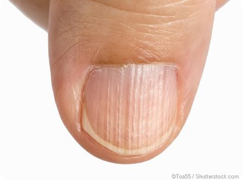 What is Longitudinal Ridging? | News-Medical Fingernail Ridges, Nail Health Signs, Nail Symptoms, Fingernail Health, Nail Ridges, Nail Problems, Nail Vitamins, Health Signs, Lines On Nails