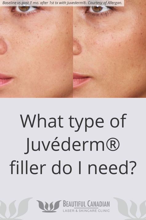 Juvéderm® is not a single dermal filler product, but many: Juvéderm® VOLBELLA® for lips. Juvéderm® VOLIFT® for smile lines. Juvéderm® VOLUMA® for cheeks. Juvéderm® ULTRA XCTM for vertical lines. Juvéderm® ULTRA PLUS XCTM for deep wrinkles. Juvéderm® VOLITE for hydration. *This photo is published for information purposes only to provide information on the nature of the intervention. It does not in any way constitute a guarantee of results. This photo is from our product or technology provider.* Juvederm Before And After Lips, Voluma Cheeks, Juvederm Before And After, Juvederm Voluma, Mouth Wrinkles, Or Nurse, Injectables Fillers, Lip Wrinkles, Lip Enhancement