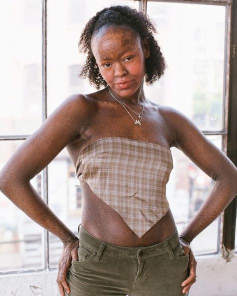 Meet Jeyźa Kaelani, a Model With a Rare Skin Condition Who Proudly Says, “I Am Allowed to Be Beautiful” Models With Freckles, Hair Whorl, Red Hair Freckles, Women With Freckles, Glamour Magazine, Body Features, Skin Condition, Natural Blondes, Light Hair