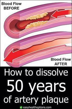 You may be at risk of a dangerous—even deadly— heart or brain disaster as a result of clogged arteries. But they don't have to stay that way! #HealthyHealthTips #DailyHealthTips Heart Or Brain, Artery Cleanse, Clean Arteries, Clogged Arteries, Health And Fitness Magazine, Healthy Diet Tips, Daily Health Tips, Soft Glam, Good Health Tips