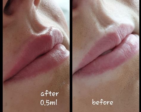 Lip Filler 5ml, .5ml Lip Filler, Lip Filler Inspiration 0.5ml, Lip Filler Inspo 0.5ml, Lip Fillers Inspiration, 0 5 Ml Lip Filler, 0.5 Lip Filler, Lip Filler 0.5ml, 0.5 Lip Filler Before And After