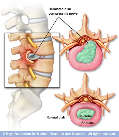 Bulging Disc, Disk Herniation, Spinal Nerve, Chiropractic Adjustment, Back Pain Remedies, Spine Health, Spine Surgery, Upper Back Pain, Sciatica Pain