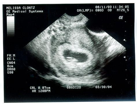 ultrasound one month | Baby ENGLISHfirst picture! Ultrasound Pictures 1 Month, Baby Sonogram Pictures, Soulmate Marks, Baby Sonogram, Sonogram Pictures, 1 Month Baby, Baby Ultrasound, One Month Baby, Not The Only One