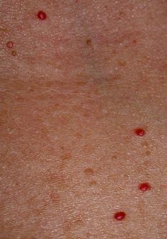 Cherry Angiomas Associated with Bromine Toxicity and Iodine Deficiency - A Man on Medicine #beautysuppliment #supplements #beautyhacks Iodine Deficiency, Thyroid Health, Natural Health Remedies, Alternative Health, Health Info, Health Facts, Natural Medicine, Nutrition Tips, Belleza Natural