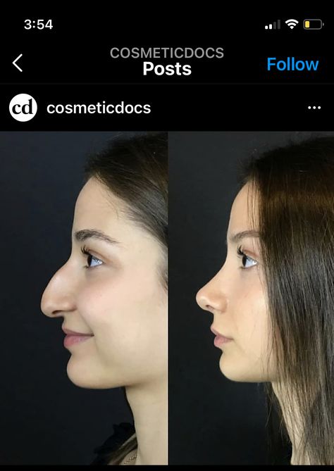 Nose Job Droopy Tip, Fake Nose Job Makeup, Nose Jobs Before And After, Aqualine Nose, Perfect Nose Rhinoplasty, Round Tip Nose, Nose Job Before And After, Nose Job Inspiration, Nose Job Inspo