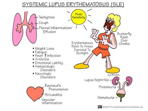 Nursing Mnemonics and Tips: Systemic Lupus Erythmatosus (SLE ... Lpn School, Med Surg Nursing, Nursing Mnemonics, Surgical Nursing, Medical Surgical Nursing, Nursing School Survival, Nursing School Studying, Med Surg, Nursing School Tips