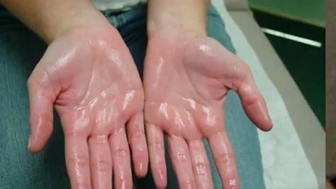 How to Treat Sweaty Hands - Masala TV Sweating Too Much, Sweaty Palms, Stop Sweating, Sweaty Hands, Body Sweat, Homemade Laundry, Sweat Gland, Excessive Sweating, Skin Issues