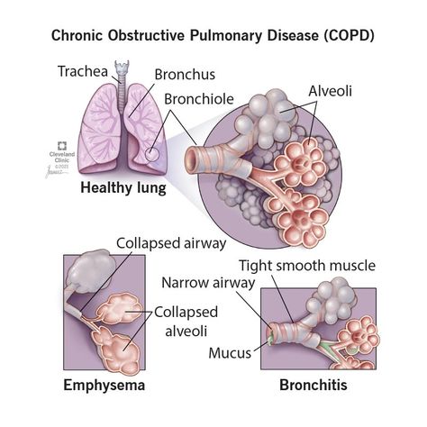 What Is Chronic Obstructive Pulmonary Disease (COPD)? Shortness Of Breath Causes, Arterial Blood Gas, Lung Infection, Persistent Cough, Hospice Nurse, Chronic Obstructive Pulmonary Disease, Respiratory Infection, Pulmonary Disease, Genetic Disorders