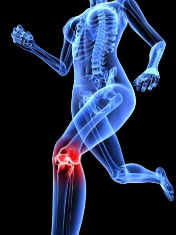 http://www.aurawellnesscenter.com/2014/02/21/how-to-protect-the-knees-in-yoga-classes/ Patellofemoral Pain Syndrome Exercises, Patellofemoral Pain Syndrome, Knee Pain Exercises, Orthopedic Surgeon, Yoga Anatomy, Nerve Pain Relief, Knee Exercises, Knee Pain Relief, Knee Replacement