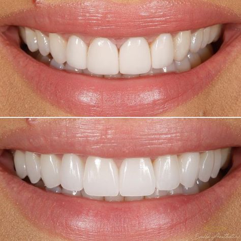 Beautiful Smile Teeth Aesthetic, Tetracycline Stained Teeth, Perfect Smile Teeth Porcelain Veneers, Small Teeth Smile, Perfect Smile Teeth Women, Veneers Teeth Styles, Beautiful Teeth Smile, Perfect Teeth Aesthetic, Veneers Before And After