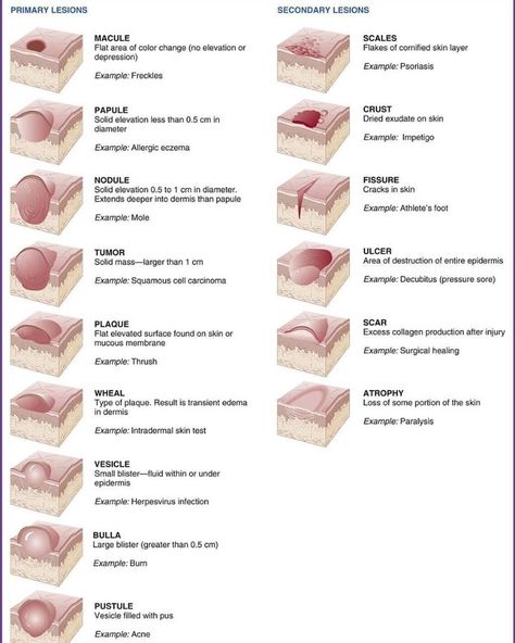 Medical Case Presentation 在 Instagram 上发布：“🔹️Different types of skin lesions . 🔸️Types of primary skin lesions  Birthmarks are primary skin lesions, as are moles, rashes, and acne.…” Cosmetology State Board Exam, Cosmetology State Board, Skin Lesions, Esthetician Inspiration, Skin Anatomy, Nurse Study, Medical Esthetician, Esthetician School, Case Presentation