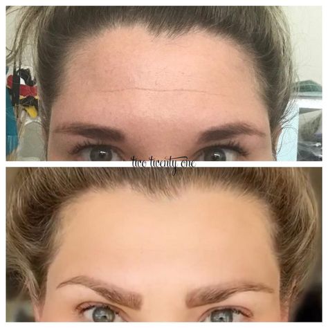 Botox Before and After - My Botox Experience Botox Forehead, Botox Injection Sites, Botox Cost, Botox Before And After, Eyebrow Growth, Botox Fillers, Forehead Wrinkles, Botox Injections, Hair Removal Device