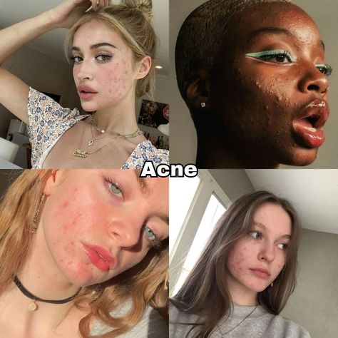 Beautiful insecurities pt.1✨ It's completely normal to have insecurities, but remember that true beauty comes from within. Focus on your positive qualities and embrace your unique features. Remember, you're amazing just the way you are! 😊🌟 Save for later📌 Like, share comment✨ Follow for more!> #acne#freckles#bigforehead#bignose#smalllips#thickeyebrows#teethgap Beautiful Insecurities Acne, Beautiful Insecurities Nose, Embracing Insecurities, Acne Confidence, Acne Is Beautiful, Normal Body Type, Beautiful Acne, Youre Amazing, Acne Positivity