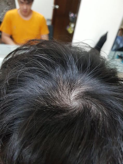 Normal cowlick or balding?- ThorGift.com - If you like it please buy some from ThorGift.com Cowlick Hair, Latest Ghana Weaving Hairstyles, Hair Growth Patterns, High Top Fade, Goatee Beard, Tight Braids, Men's Hairstyle, Celebrity Design, Normal Hair