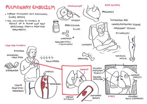 PE Armando Hasudungan, Dvt Awareness, Nursing Respiratory, Medsurg Nursing, Concept Map Nursing, Disease Infographic, Paramedic School, Acute Coronary Syndrome, Cardiac Rhythms