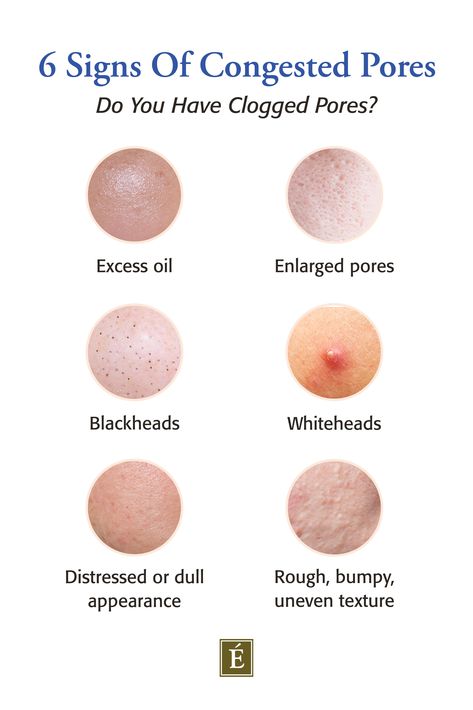 Can You Get Clogged Pores At Any Age? The Causes And Solutions | Eminence Organic Skin Care Taking New Clients, Congested Pores, Medical Esthetician, Pore Mask, Skincare For Oily Skin, Eminence Organic Skin Care, Workout Nutrition, Beauty App, Skin Care Ingredients