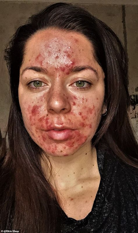 Personal trainer who had the 'worst acne ever seen' shares her striking before and after pictures | Daily Mail Online Acne Pictures, Before And After Acne, Blind Pimple, Face Mapping Acne, Bad Acne, Natural Acne Remedies, Severe Acne, How To Get Rid Of Pimples, Foot Soak