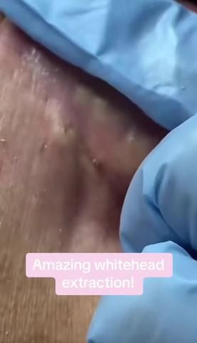 PimpleTok (@pimple.tok) | TikTok Leg Pimples, Boil Popping Videos, Hard Pimple, Body Pimples, Lip Pimple, Zit Popping, Pimple Cream, Zit Popping Videos, 4k Followers