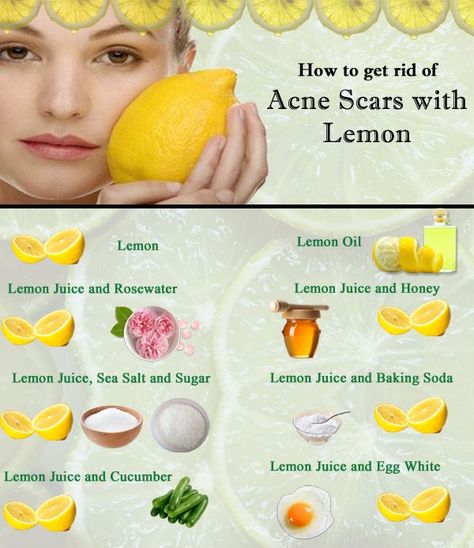 How to clear Acne scars with lemon juice? DIY honey and lemon face mask for acne... Honey And Lemon Face Mask, Mascara Tricks, Honey For Acne, Holistic Products, Face Mask For Acne, Acne Scar Mask, Lemon Face, Mask For Acne, Lemon Face Mask