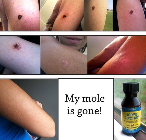 Castor Oil For Mole Removal, Remove Moles Naturally, How To Remove Moles, Skin Tags On Face, Remove Moles, Remedies For Skin, Remove Skin Tags Naturally, Clean Baking Pans, Home Remedies For Skin