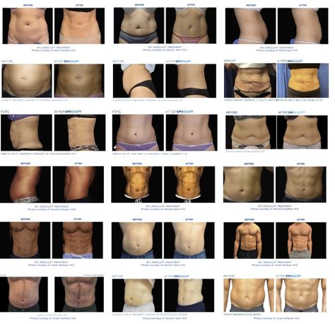 Emsculpt Before & After Photos Muscle Stimulator Before And After, Cool Sculpting Before And After Stomach, Non Invasive Body Sculpting, Emsculpt Neo Before And After, Body Sculpting Before And After, Emsculpt Before And After, Body Sculpting Room Ideas, Emsculpt Neo, Internal Organs