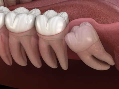 Wisdom Teeth Recovery, Impacted Wisdom Teeth, Teeth Surgery, Impacted Tooth, Gum Surgery, Dental Extraction, Wisdom Tooth Extraction, Jaw Surgery, Wisdom Teeth Removal