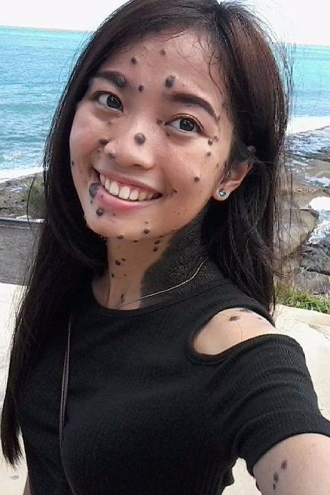 How 1 Woman Learned to Embrace Her Body Covered in Moles Moles On Face, Monster Head, Beatiful People, Beauty People, Bare Beauty, Poses References, Miss Universe, Silver Lining, Skin Conditions