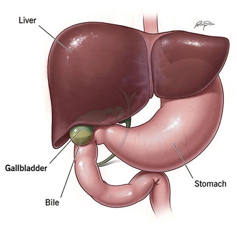 Gallbladder Surgery Diet, Pancreatic Diet Recipes, After Gallbladder Surgery, Gallbladder Flush, Gallbladder Cleanse, Gallbladder Diet, Gallbladder Surgery, Gut Inflammation, Bile Duct