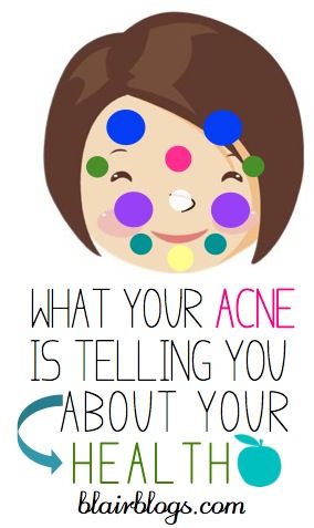 Acne Causes, Acne Facial, Acne Remedies, Health And Beauty Tips, Facial Care, Hair Skin, Beautiful Skin, Skin Health, Beauty Care