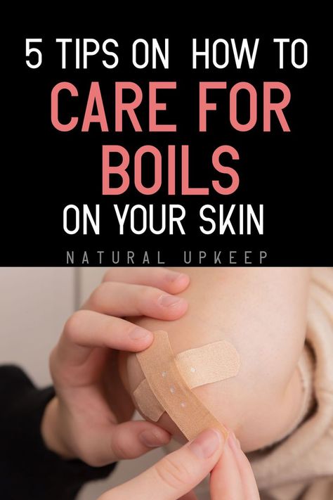 Boil Remedies, How To Treat Boils, Get Rid Of Boils, Home Remedy For Boils, Skin Boil, Under The Skin, Daily Health Tips, Best Soap, Skin Remedies