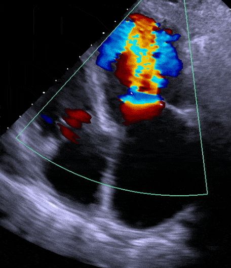 Echocardiogram vs. EKG – Explained By A Cardiologist • MyHeart Coarctation Of The Aorta, Heart Catheterization, Cardiac Sonography, Fast Heart Rate, Sonography Student, Heart Structure, Abdominal Aorta, Heart Echo, Hospital Admit