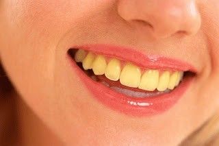 Teeth Aesthetic, Best Teeth Whitening Kit, Discolored Teeth, Teeth Whitening Remedies, Laser Teeth Whitening, Perfect Teeth, Teeth Braces, Yellow Teeth, Tooth Enamel