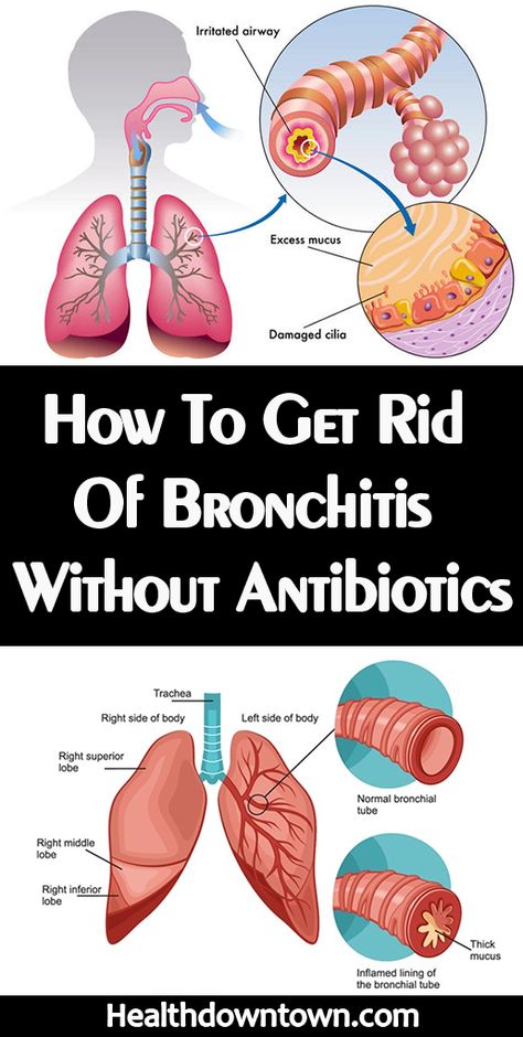 Remedies For Bronchitis, Home Remedies For Bronchitis, Top 10 Home Remedies, Congestion Relief, Sinus Congestion, Chest Congestion, Health Podcast, Creating A Newsletter, Cough Remedies