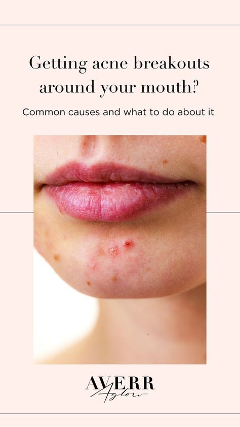 Breakouts Around Mouth, Acne Around Mouth, Mouth Acne, Chin Breakouts, Chin Acne, Acne Causes, Acne Breakout, Medical Aesthetic, Clean Skincare