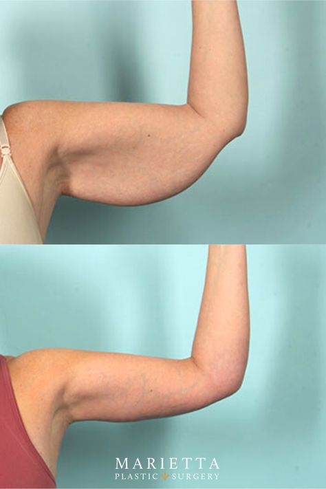 Before And After Arm Workout, Arms Before And After Toned, Before After Aesthetic, Arm Surgery Plastic Before After, Arms Before And After, Skin Removal Surgery Before And After, Arm Lift Surgery Before And After, Arm Lipo Before And After, Emsculpt Before And After