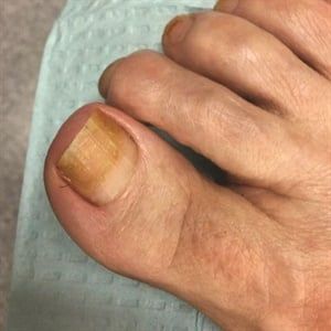 A Day in the Life of a Nail Expert: Yellow Nails - Wellness - NAILS Magazine Yellowing Nails Remedy, Dark Toe Nails Remedy, Toenail Whitening, Yellow Toe Nails, Nails School, Nail Disorders, Nail Remedies, Nail Discoloration, Nail Problems