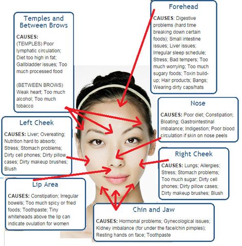 Causes Of Pimples On Face, Acne On Temples, Pimple Face Mapping, Doterra Acne, Gesicht Mapping, Face Map, Holistic Skincare, Body Board, Face Mapping Acne