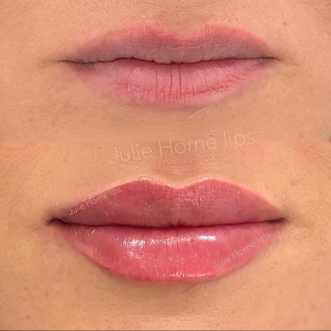 Facial Aesthetics 🇬🇧 on Instagram: “Perfectly natural results with 1ml lip filler 😍👄 Do you like the results?🤔👇 Via @juliehornelips ⤵️ Follow @botoxnfillers for more 💉 🤔Chin…” Lip Fillers Juvederm, 1ml Lip Filler, Restylane Lips, Lips Inspiration, Face Fillers, Permanente Make-up, Botox Lips, Aesthetic Dermatology, Facial Fillers