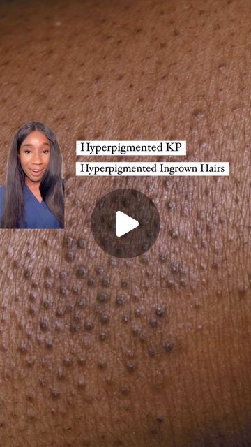 Dr Kemi Fabusiwa on Instagram: "Hyperpigmentation left behind by KP and ingrown hairs?? You DON’T have to settle for that uneven skin tone. ✨💖✨

Here’s my little recipe for smoother, more even-toned skin:

1️⃣ Exfoliate: Salicylic acid is your BFF here! It gently sloughs off dead skin cells, unclogs pores, and helps fade those pesky dark spots.

2️⃣ Brighten & Moisturize: A glycolic acid product with shea butter is the dream team! It exfoliates deeper to reveal brighter, smoother skin while the shea butter keeps your skin hydrated and happy. 🧈💖

3️⃣ Renew: A retinoid body moisturizer is a game-changer! It speeds up cell turnover, fading dark spots and preventing new ones from forming. But start slow and wear your SPF, okay? 🧴💖

#skincare #KP #hyperpigmentation #melaninskin #skincarero Body Hyperpigmentation Products, Glass Body Skin, Face Discoloration, Body Hyperpigmentation, Hyperpigmentation Black Skin, Best Body Moisturizer, Melanin Skin, The Dream Team, Body Therapy