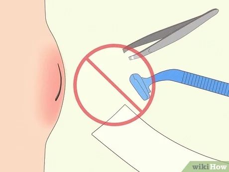 3 Simple Ways to Remove Deep Ingrown Hairs - wikiHow How To Remove Ingrown Hair, Essential Oil For Boils, Itchy Legs, Infected Ingrown Hair, Treat Ingrown Hair, Ingrown Hair Remedies, Ingrown Hair Removal, Ingrown Hairs, Hair Curling